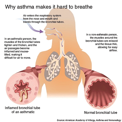 Why Asthma Makes it hard to breathe